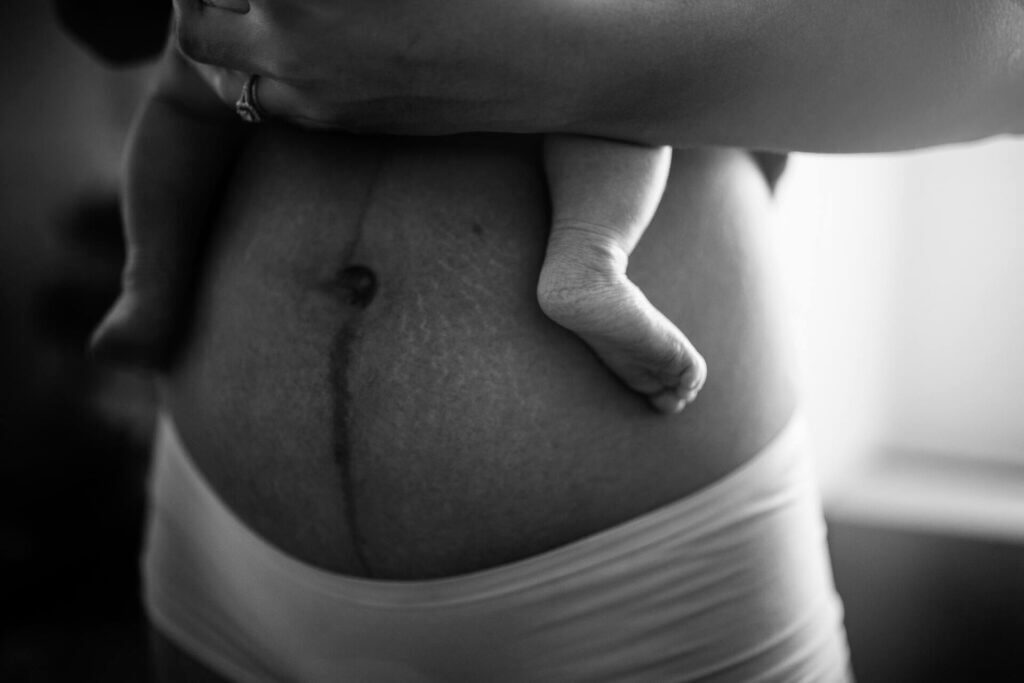lose-up photo of a woman’s belly and stretch marks as she holds her baby, whose legs dangle