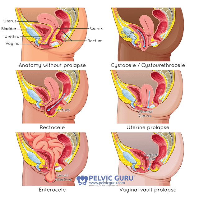 Side view of female reproductive anatomy depicting six images that show all the different types of prolapse that can occur