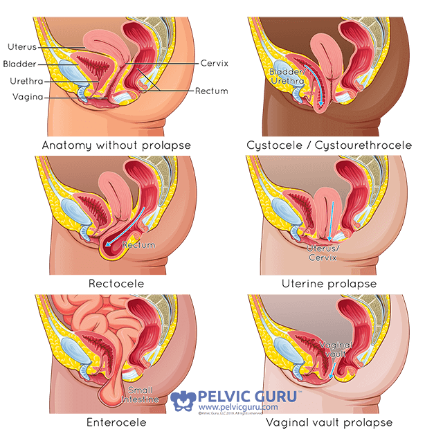 cystocele grading