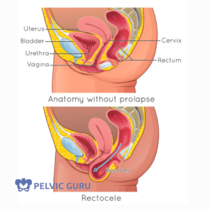 rectal prolapse and rectocele